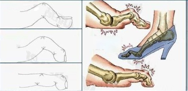 молоткообразная деформация