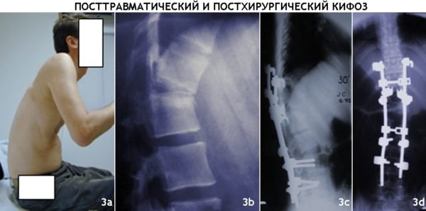 Посттравматический и постхирургический кифоз