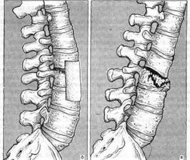 Возникнуть перелом может на почве остеопороза, а также из-за сильного давления извне