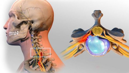 Межпозвоночная грыжа