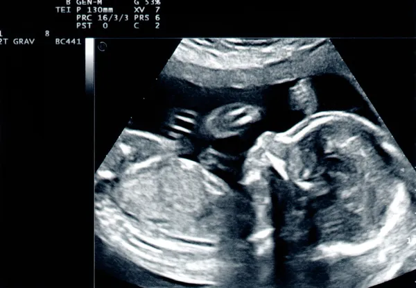 Ультразвуковое сканирование baby — стоковое фото
