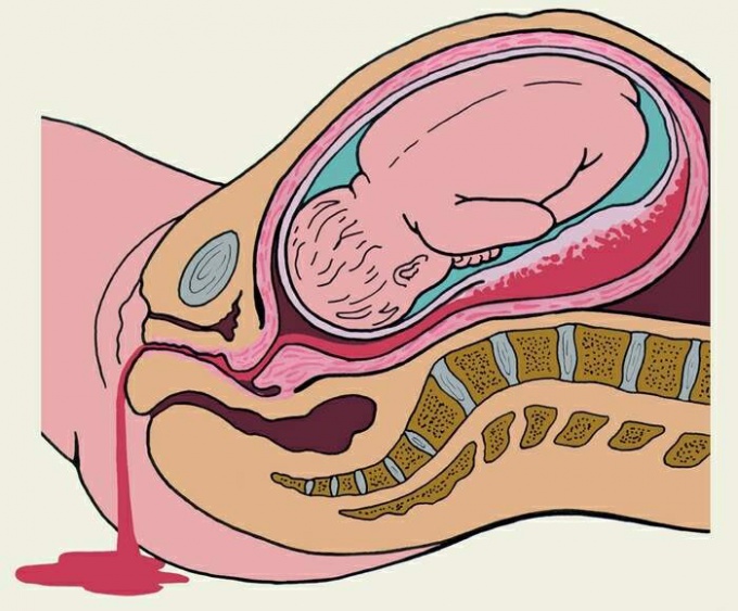 Как рассасывается гематома при беременности