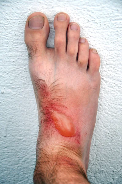 Phytophotodermatitis, кожный фототоксических кожи воспалительного eru — стоковое фото
