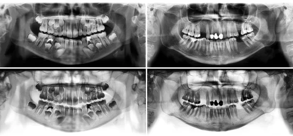 Panoramic dental x-ray tooth's of young man of 30 thirty and child of 7 seven years — стоковое фото