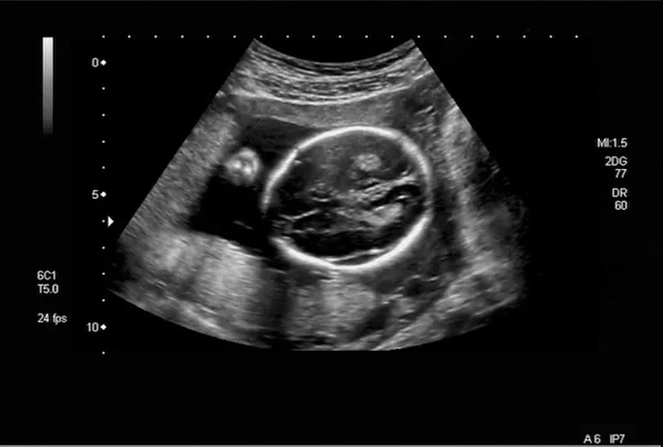 Эмбриональный utrasound — стоковое фото