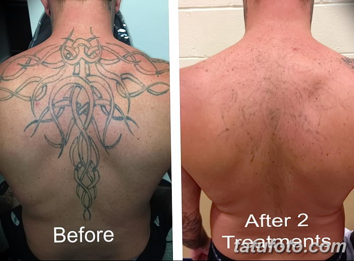 фото Выведение тату лазером от 14.01.2018 №021 - Laser tattoo removal - tatufoto.com