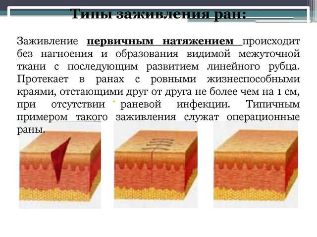 Первичное натяжение повреждение