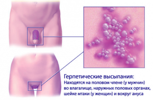 Локализация генитального герпеса