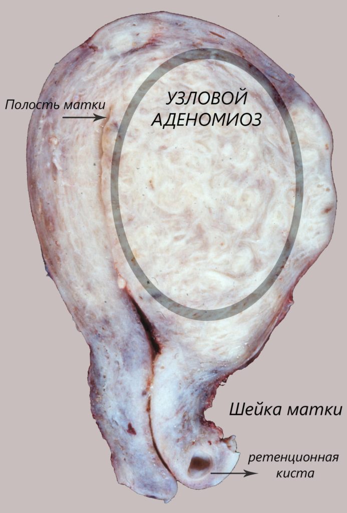 Узловая форма аденомиоза матки 