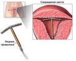 Спираль как метод контрацепции