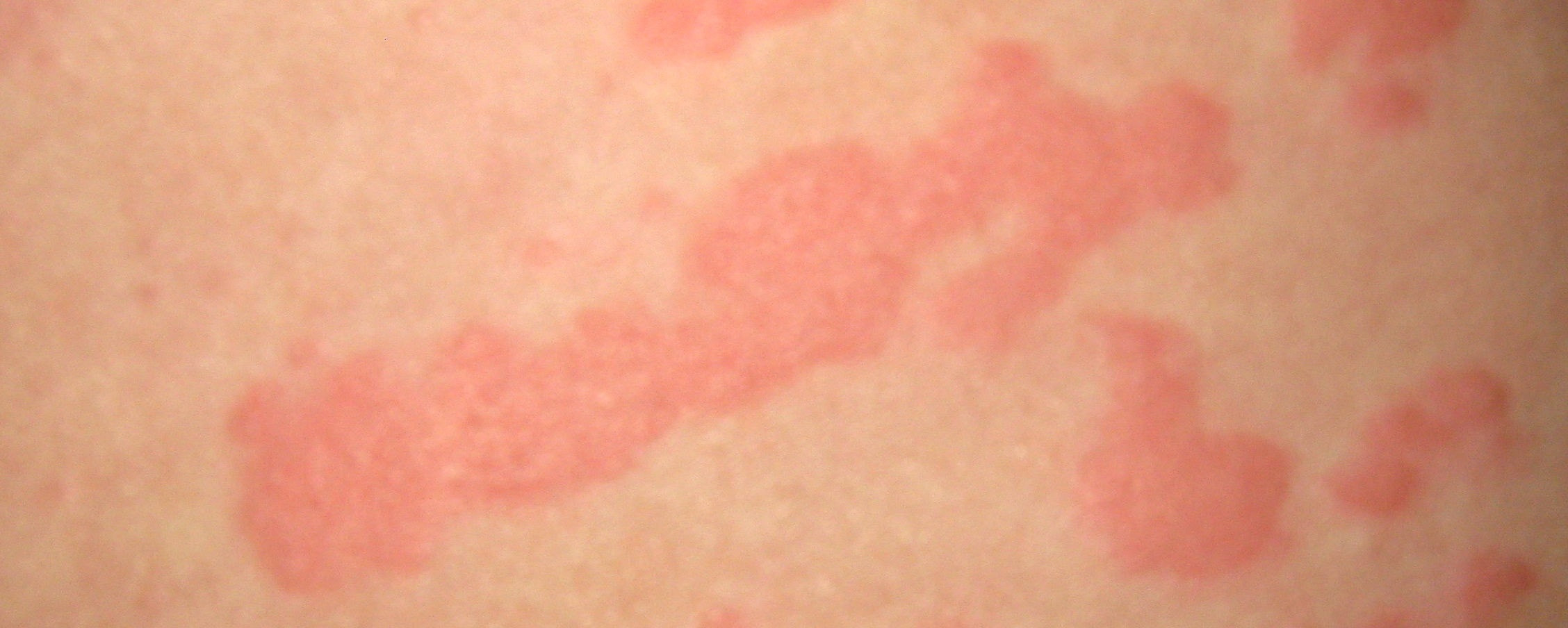 Крапивница может стать - проявлением аллергии кожи лица на холод
