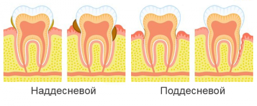 Два вида зубного камня