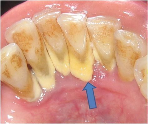 Зубной камень на зубах