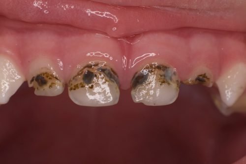 Черные зубы от кариеса