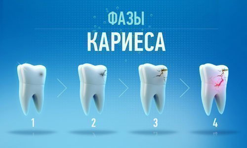 Стадии развития кариеса