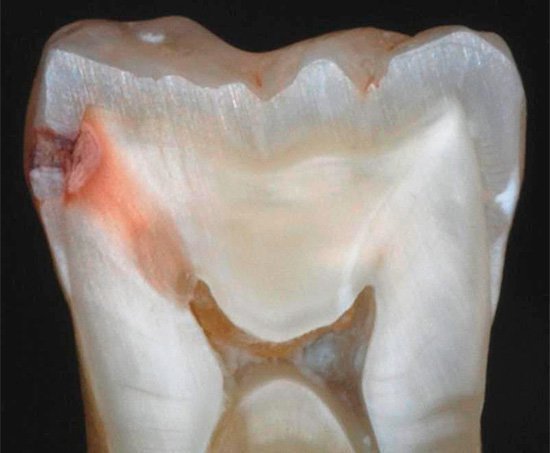 Кариес на зубе в разрезе