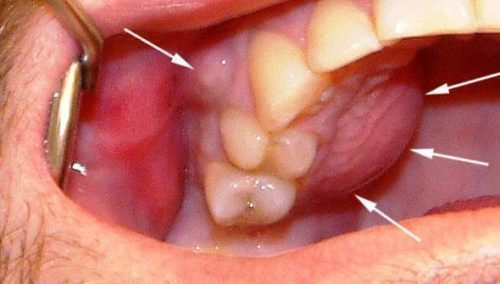 Резкая отечность десны около зубов
